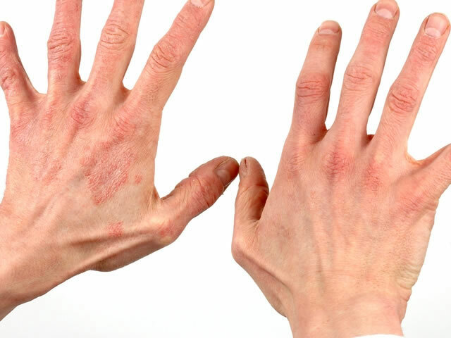 Kontakt dermatitis: tünetek és kezelés