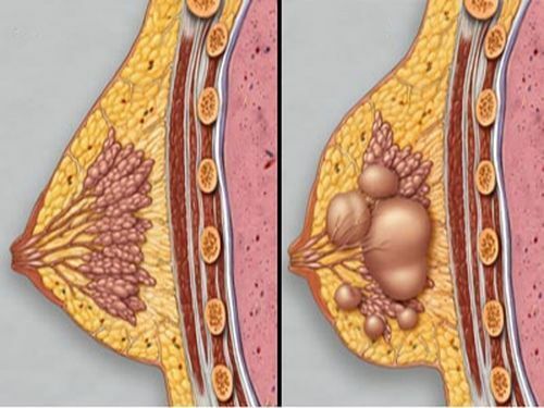 Types of benign breast tumors