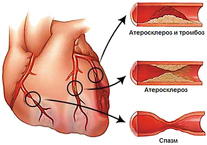 Causes of myocardial infarction