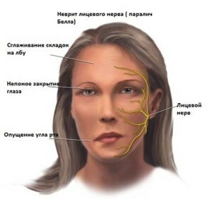 Inflammation du nerf facial: symptômes et méthodes populaires de traitement de la maladie