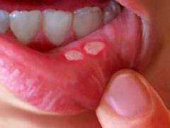 stomatitis i munden, behandling