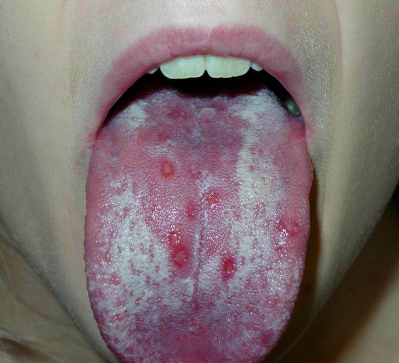 Acute herpetic stomatitis in children: treatment, symptoms