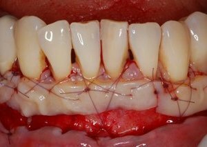 Fibromatosis( hyperplasia) of gums
