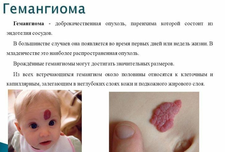 Hemangioma: symptoms, diagnosis, treatment in children