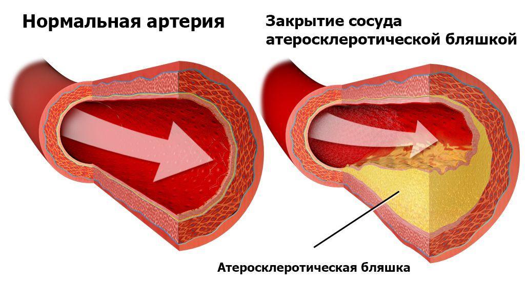 Isquemia cardíaca