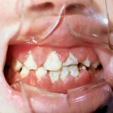 Gingivitis: ziekten van de mondholte bij kinderen
