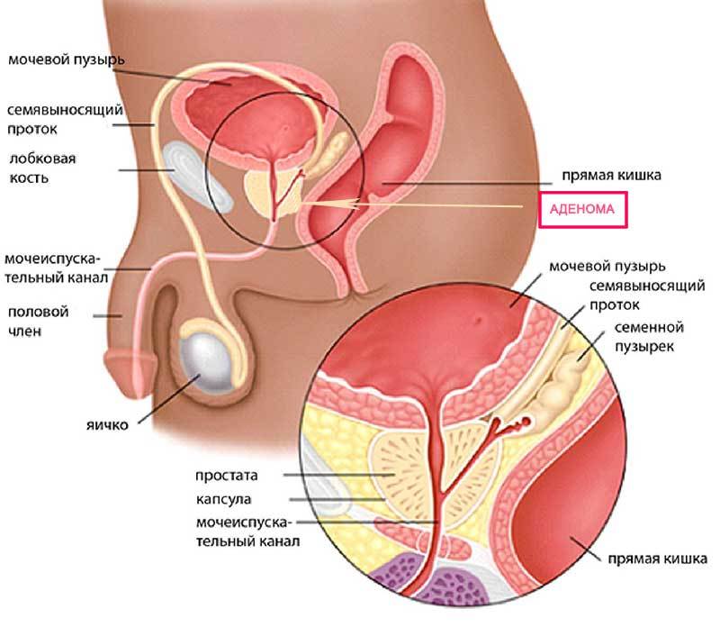De huidige therapie van prostaatkanker adenoom: beoordelingen van prostaplante