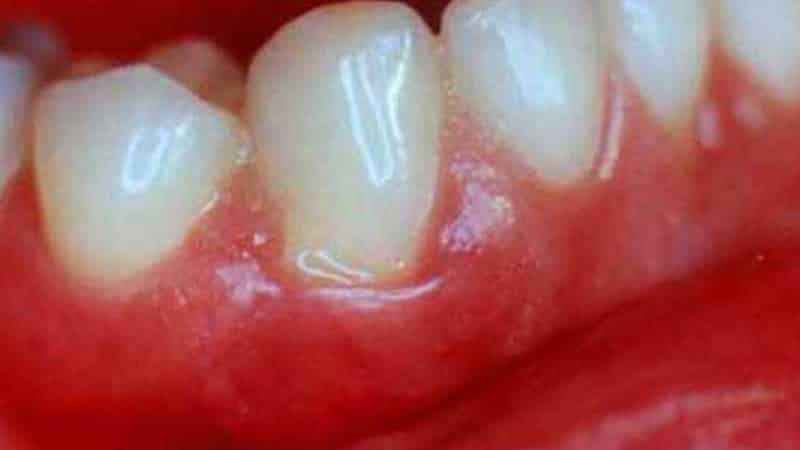 Geschwollenes Zahnfleisch um den Zahn zu tun