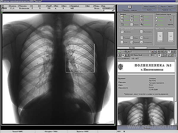 5-digital fluorografická
