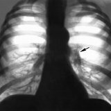 Akutes pulmonales Herz: Klinik Diagnose Behandlung