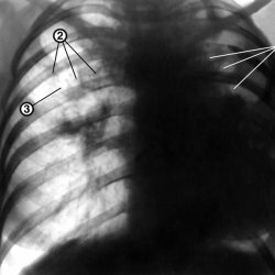 Caseous tüdőgyulladás: hogyan kell felismerni és hogyan kell harcolni?