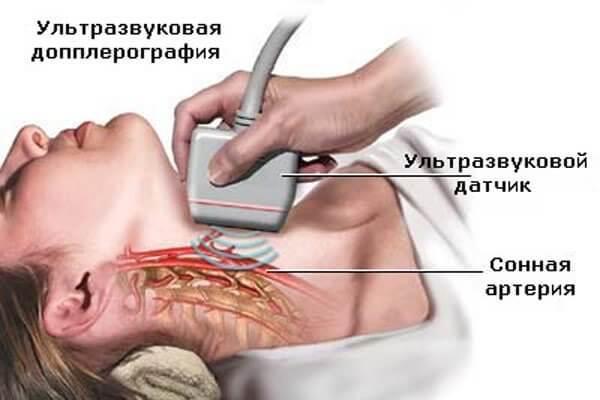 Doppler ultrazvuk žila glave i vrata (Doppler ultrazvuk): što je to