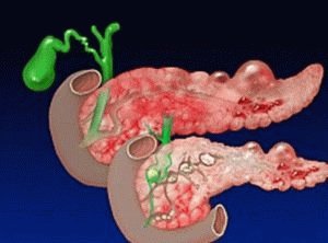 Ontwikkeling van pancreatitis