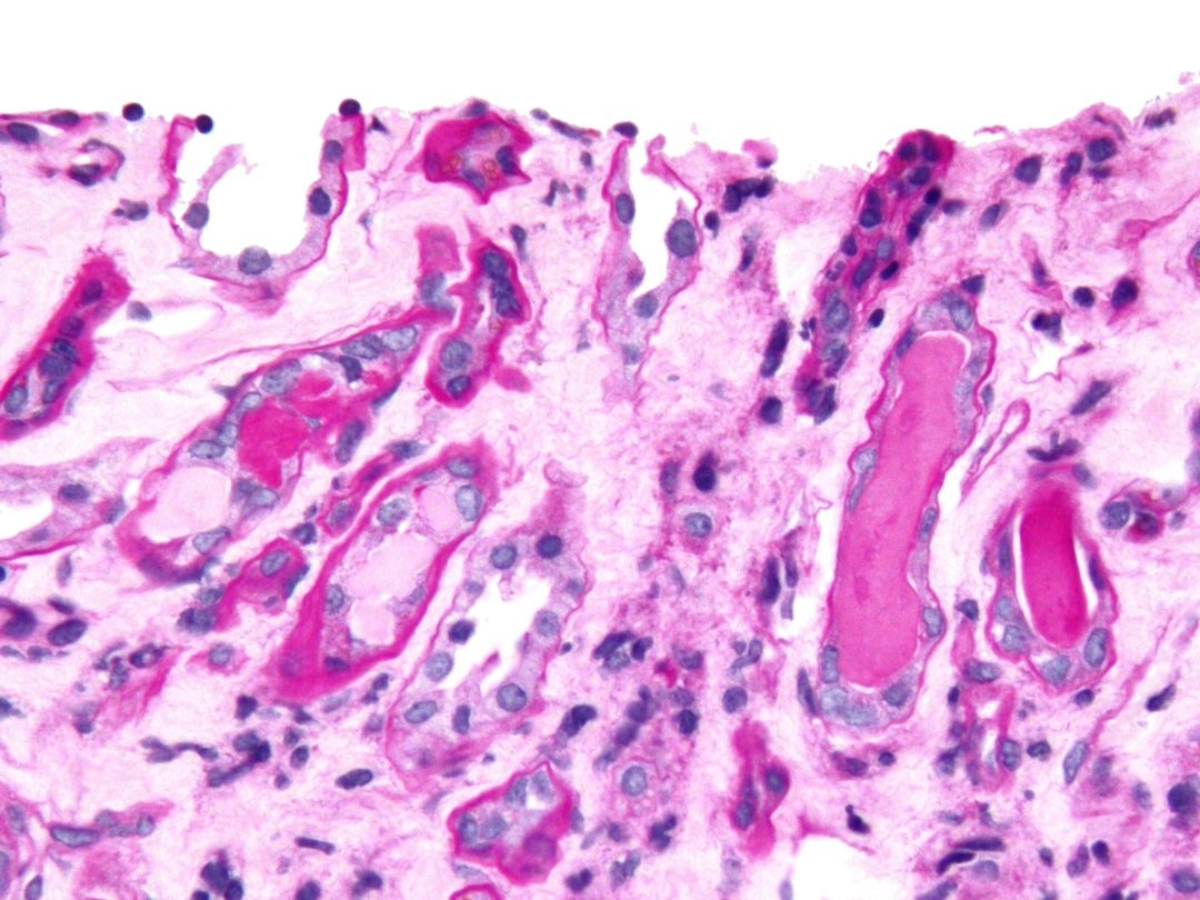 Wegener's granulomatosis: what is it, causes, symptoms (photo), treatment