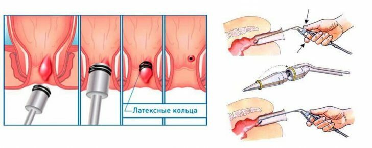 Removal of external hemorrhoids - methods of surgical intervention