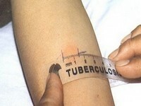 Trial for tuberculosis