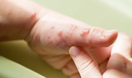 Symptome von Herpes an den Händen und Fingern - Foto