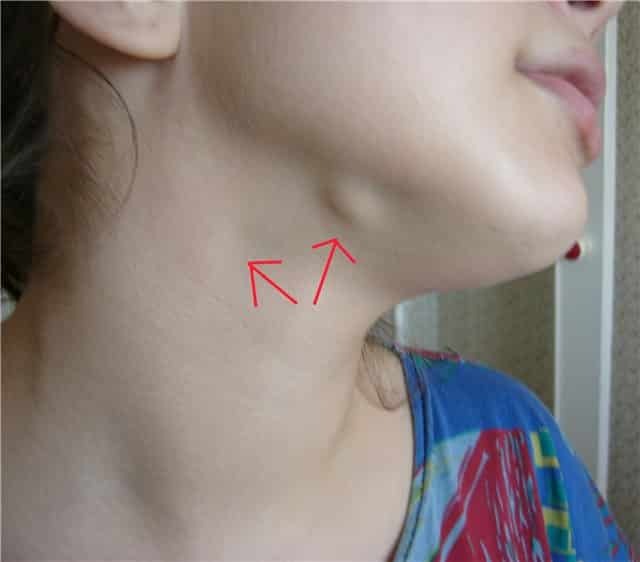 Entzündung der geschwollenen Lymphknoten unter dem Kiefer
