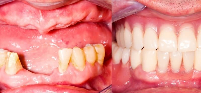 prótese na ausência de dentes