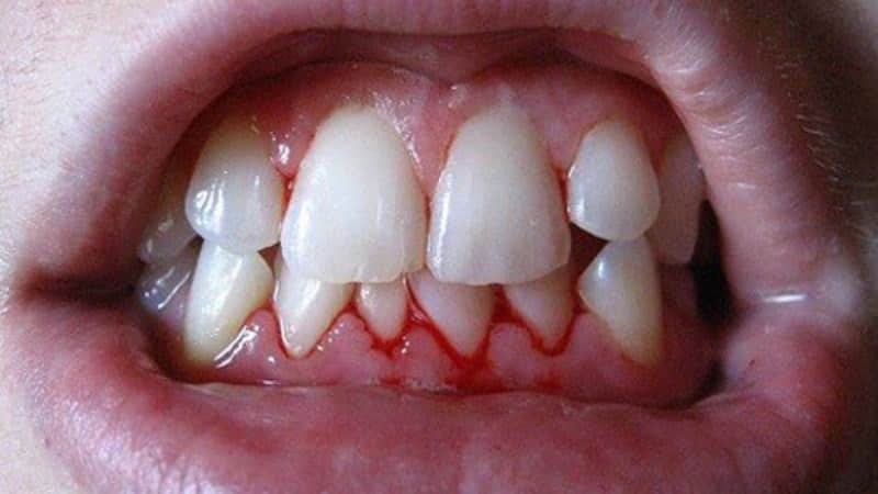 Den adskiller sig fra paradentose periodontitis