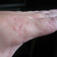 How to treat eczema on the hands
