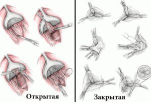 Atvira hemorrhoidektomija