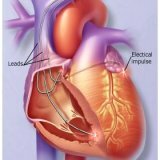 Treatment of heart rhythm disturbances