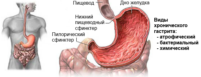 Charakteristiky antralovej gastritídy a spôsoby jej liečby