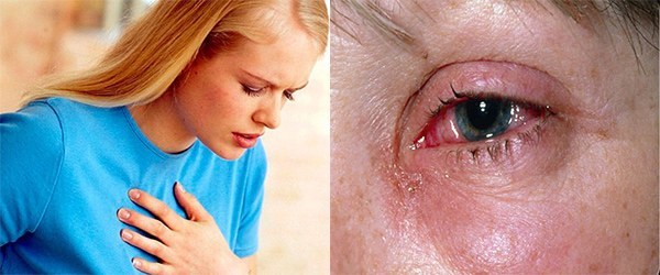Madárcseresznye allergia: okok, tünetek, kezelés