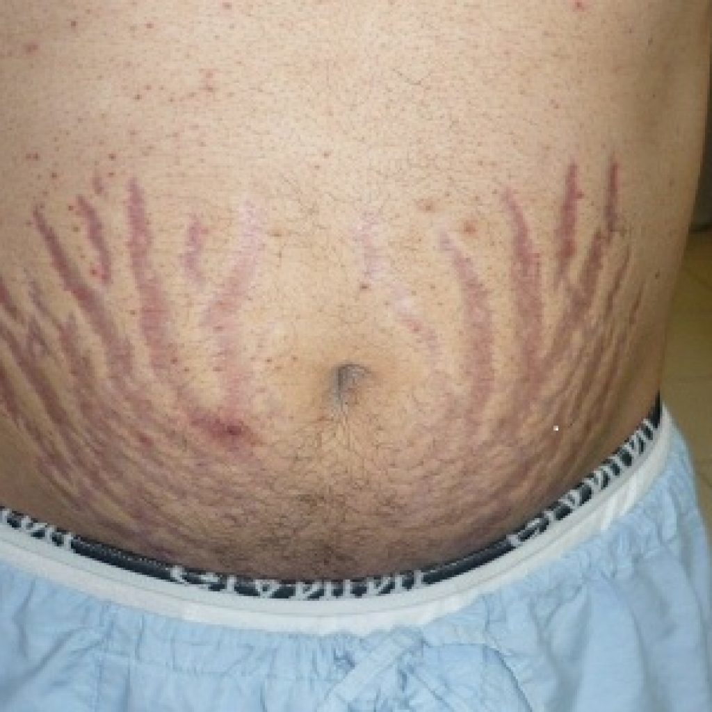 Ziekte van Itsenko-Cushing: oorzaken, symptomen (foto), behandeling