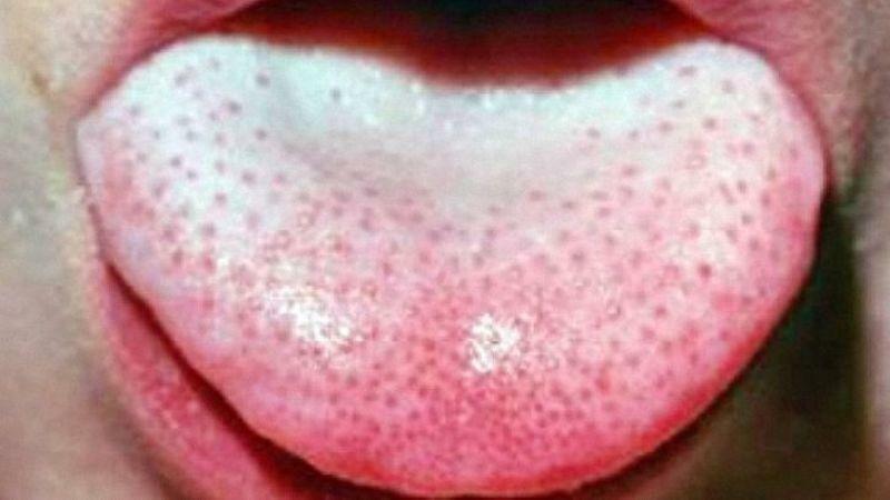 nella lingua del rash cutaneo negli adulti