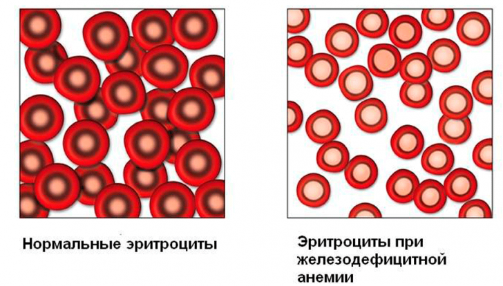Causes of low hemoglobin