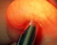 Diaphanoscopy for diagnosis of testicular condition
