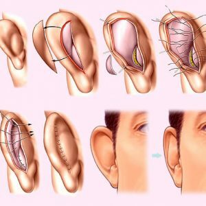 Deformation von Ohren und Otoplastik