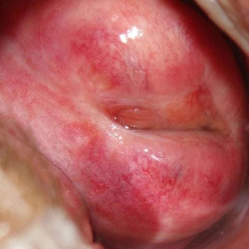Erosion of the cervix: causes, symptoms, diagnosis, treatment