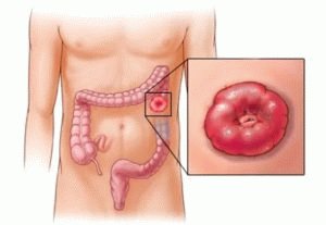 Colotomie van het rectum