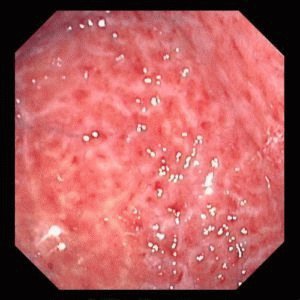 Chronische gastritis