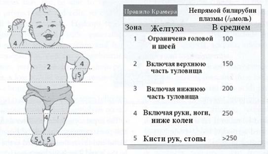 zheltushka-in-3-rate novorođenčeta