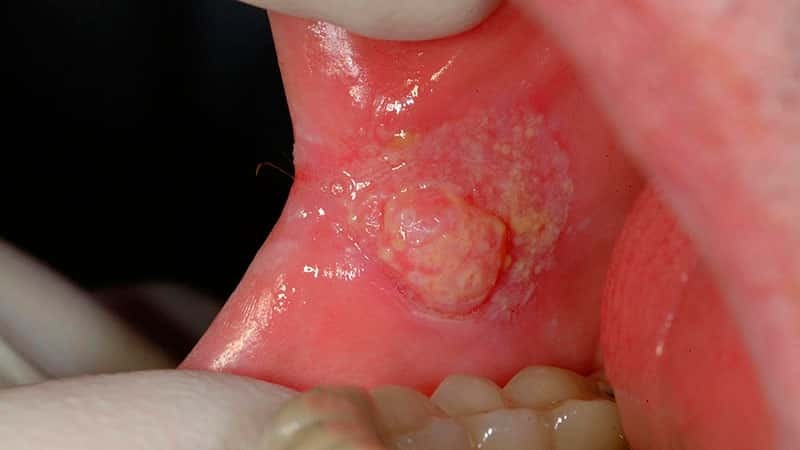 Comment traiter les ulcères de la bouche