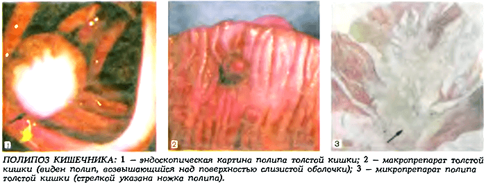 Polyposis, intestinale