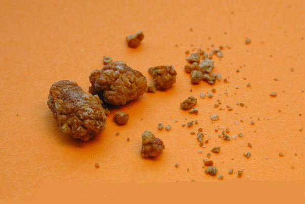 Kidney stones-can-be-different-sized