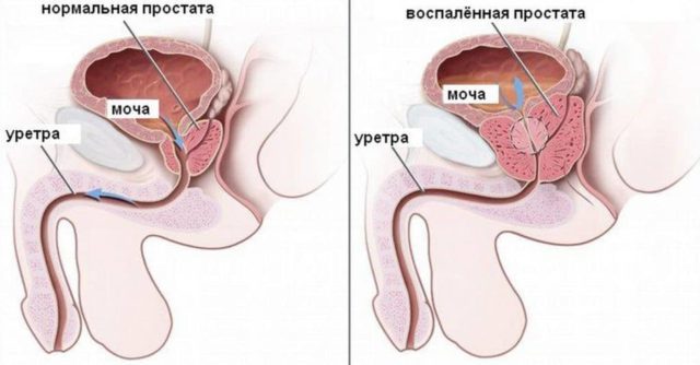 Inflammation of the prostate and its symptoms