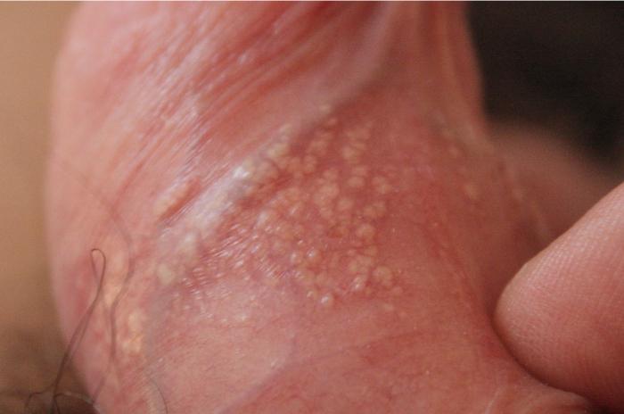 With what may be due to the formation of acne on the penis?