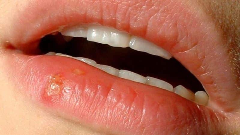Weiße Beulen auf den Lippen: Foto