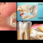 Why remove the wisdom tooth