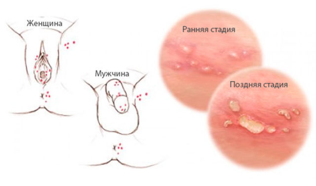 Das Auftreten von Akne am Bauch bei Männern: Ursachen und Behandlung