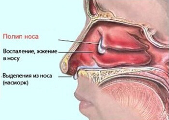 Benigni tumori nosnoj šupljini