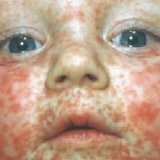 Measles in children: symptoms, treatment