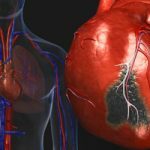 srce bolest-vizualno-vodič-S2-srce-napad
