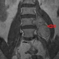 Treatment of neurinoma of the spine